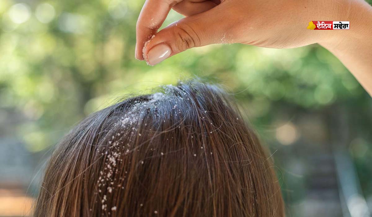 Hair Care : ਸਿਰਫ਼ ਚਿਹਰਾ ਹੀ ਨਹੀਂ… ਗਰਮੀਆਂ ‘ਚ ਸਕੈਲਪ ਦੀ ਦੇਖਭਾਲ ਵੀ ਹੈ ਜ਼ਰੂਰੀ ; ਇਨ੍ਹਾਂ 8 ਸੁਝਾਵਾਂ ਦੀ ਕਰੋ ਪਾਲਣਾ