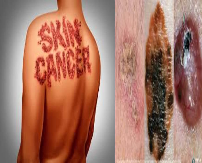 AI opens new avenues: Technology that identifies skin cancer risk in advance has become a new revolution in the health sector
