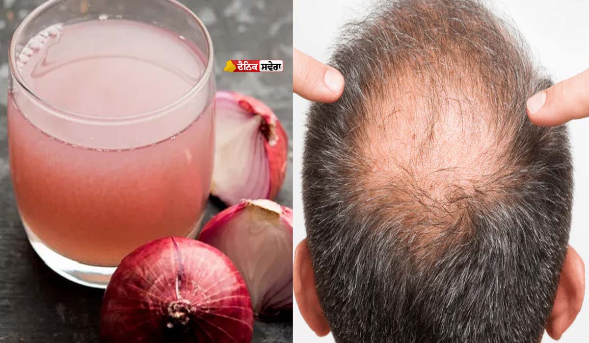 Onion for Hair : ਤੇਜ਼ੀ ਨਾਲ ਲੰਬੇ ਤੇ ਸੰਘਣੇ ਹੋਣਗੇ ਵਾਲ ; ਬਸ ਜਾਣ ਲਓ ਪਿਆਜ਼ ਨੂੰ ਇਸਤੇਮਾਲ ਕਰਨ ਦਾ ਸਹੀ ਤਰੀਕਾ