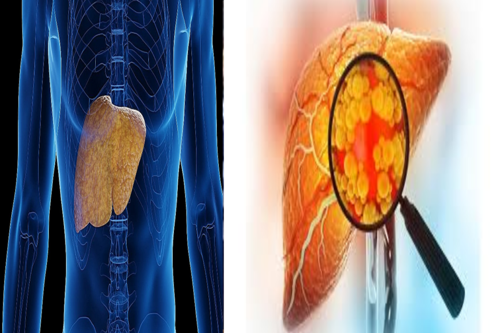 Adopt these healthy habits to get rid of fatty liver, liver will remain healthy