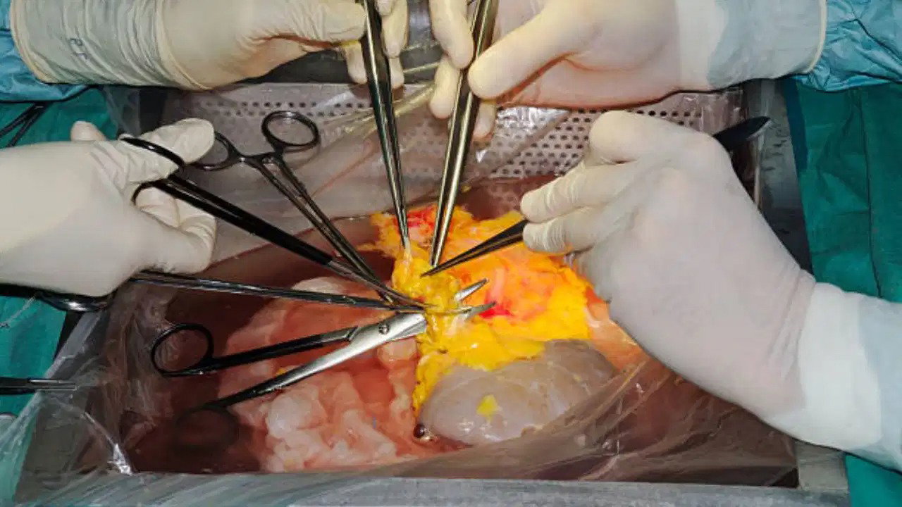 Kidney Transplant: ਸੂਰ ਦੀ ਕਿਡਨੀ ਦੇ ਸਹਾਰੇ 271 ਦਿਨ ਤੱਕ ਜ਼ਿੰਦਾ ਰਿਹਾ ਸ਼ਖ਼ਸ, 9 ਮਹੀਨੇ ਬਾਅਦ ਹੋਇਆ ਸਫਲ ਟ੍ਰਾਂਸਪਲਾਂਟ