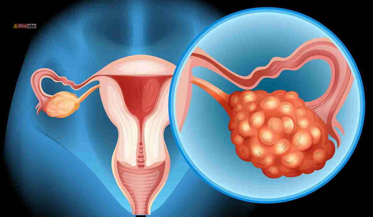 Health : ਆਯੁਰਵੇਦ ਨਾਲ ਹੋ ਸਕਦਾ ਅੰਡਕੋਸ਼ ਦੀਆਂ ਗੰਢਾਂ ਦਾ ਇਲਾਜ ! ਯੋਗ ਤੇ ਪੰਚਕਰਮ ਕਿਵੇਂ ਹੋ ਸਕਦਾ ਲਾਹੇਵੰਦ ; ਜਾਣੋ