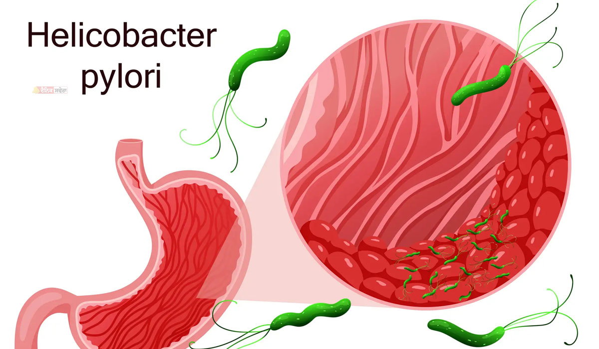 H. Pylori : ਵਾਰ-ਵਾਰ ਹੋਣ ਵਾਲੀ ਐਸਿਡਿਟੀ ਸਿਰਫ਼ ਗੈਸ ਦੀ ਸਮੱਸਿਆ ਨਹੀਂ ; ਪੇਟ &lsquo;ਚ ਹੋ ਸਕਦਾ ਇਹ ਬੈਕਟੀਰੀਆ, ਇਵੇਂ ਕਰੋ ਪਤਾ